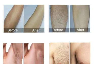  هل الليزر المنزلي يزيل الشعر نهائيًا؟ الحقيقة الكاملة في السعودية